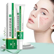 Herbal Acne Treatment Cream Face Scar Blackhead Remover Repair Gel Oil Control Shrink Pores Whitening Skin Care Korean Cosmetics (Copy)