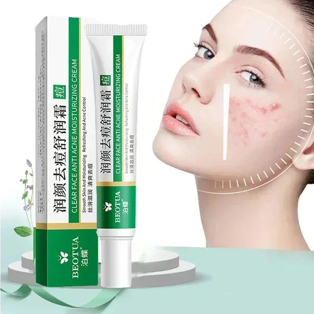 Herbal Acne Treatment Cream Face Scar Blackhead Remover Repair Gel Oil Control Shrink Pores Whitening Skin Care Korean Cosmetics (Copy)