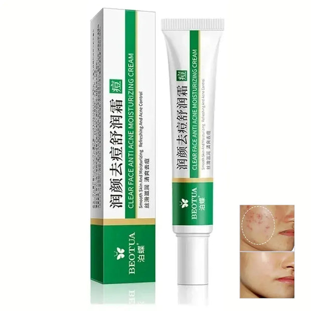 Herbal Acne Treatment Cream Face Scar Blackhead Remover Repair Gel Oil Control Shrink Pores Whitening Skin Care Korean Cosmetics (Copy)